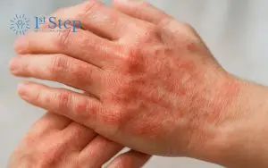 What Are Meth Sores