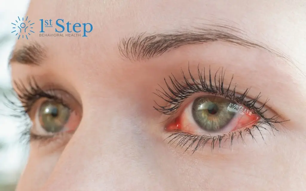 Recognizing Heroin Eyes and Other Signs of Heroin Addiction